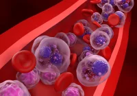 Osteolysis Detection in Multiple Myeloma with MRI and Black Bone Pseudo-CT