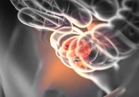 How to Manage Pelvic Recurrence of Rectal Cancer with MRI