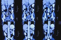 DL Harmonisation in Abdominal CT Imaging: Advancing Radiomics Reliability