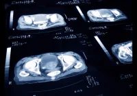 Low-Field MRI in Prostate Cancer Screening: A Viable Alternative to 3T?