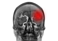 The Role of DL in Estimating Ischaemic Lesion Age