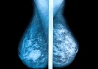 Non-Detected Cancers in One-View Breast Screening