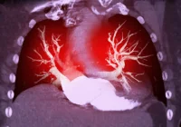 The Role of DL Reconstruction in Spectral CT Pulmonary Angiography