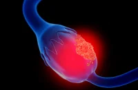 Updated Imaging Guidelines for Ovarian Cancer