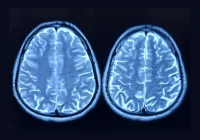 Optimising Multimodal Prompts for GPT-4V in Brain MRI Diagnosis