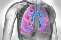CT-Based Body Composition Analysis in Lung Cancer Prognosis