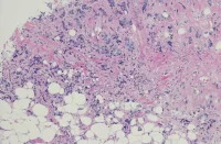 Invasive Lobular Carcinoma Detection in Breast Cancer Screening