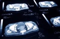 Advancing Prostate Cancer Imaging: The Role of [68Ga]Ga-PSMA-R2