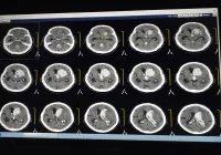 Photon-Counting Detector CT for Contrast Medium Reduction