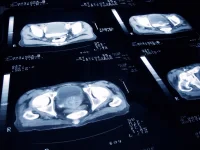 AI-Powered Prostate Cancer Detection: A Multi-Centre Study