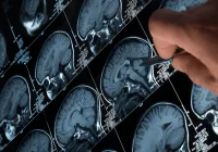 Enhancing Brain MRI Diagnosis: The Role of Human-AI Collaboration