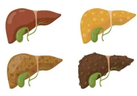 Human liver disease stages illustrated for medical education and healthcare awareness&nbsp;