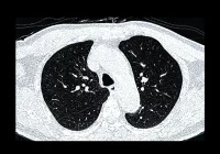 CT scan of human lungs &ndash; diagnostic imaging for lung disease, cancer, or COVID-19 evaluation
