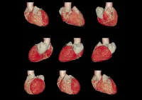 Multiview cardiac CT scan &ndash; non-invasive imaging for coronary artery disease and heart function analysis&nbsp;