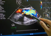  Doctor analysing colour Doppler echocardiogram on screen, highlighting heart valve blood flow and cardiac function assessment using ultrasound imaging.&nbsp;
