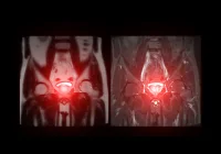 MRI scan of the pelvis highlighting the prostate gland, used for detecting prostate enlargement, inflammation or prostate cancer in male patients.&nbsp;