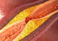 3D illustration of atherosclerosis showing arterial plaque buildup and restricted blood flow, used to explain cardiovascular disease and stroke risk.&nbsp;