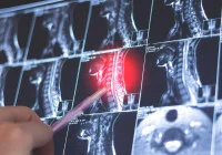 Cervical spine MRI showing highlighted spinal cord injury with a pen indicating the affected area, useful in diagnosing neurological or orthopaedic conditions.&nbsp;