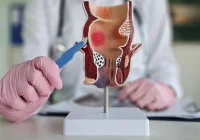 Doctor uses anatomical model to illustrate anal fissures and haemorrhoids in rectal anatomy.&nbsp;