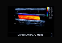 Colour Doppler ultrasound of carotid artery in C Mode, showing blood flow dynamics.&nbsp;