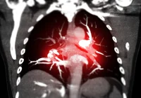 Contrast-enhanced CT scan of lungs highlighting pulmonary embolism in the pulmonary arteries