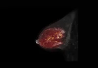 Colour-enhanced breast MRI scan showing internal tissue and vascular structure for tumour detection and breast health evaluation&nbsp;