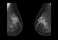 Bilateral mammogram showing breast tissue density for diagnostic evaluation.