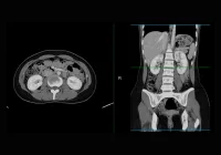 CT scan of abdomen and pelvis showing cross-sectional and coronal views for diagnostic evaluation&nbsp;
