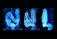 3D medical imaging of human colon for gastrointestinal diagnosis and colorectal disease screening&nbsp;