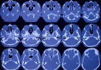 Axial CT scan of the brain showing sequential slices for neurological assessment and trauma evaluation.&nbsp;