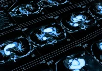 Axial chest MRI scan showing heart, lungs and major blood vessels in high contrast.&nbsp;