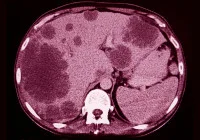 CT scan of the abdomen showing multiple liver metastases in a cross-sectional view.&nbsp;