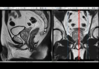 Pelvic MRI scan showing detailed cross-sectional imaging of the prostate for medical diagnosis&nbsp;