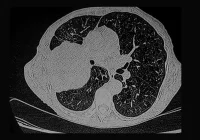 CT scan of human lungs showing cross-sectional imaging for respiratory disease diagnosis&nbsp;