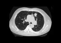 CT scan of lungs showing a pulmonary nodule, used in the diagnosis of lung cancer and respiratory disease. 