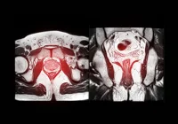 Pelvic MRI scan highlighting the prostate gland for medical diagnosis and evaluation