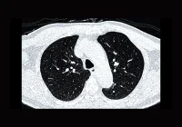 CT chest scan used to assess respiratory structures and detect lung disease&nbsp;