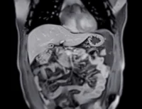 Diagnostic MRI scan of abdomen assessing liver and gastrointestinal structures&nbsp;
