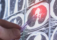 Radiologist highlighting a lung nodule on CT scan for low-dose lung cancer screening.&nbsp;