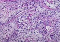 Microscopic view of carcinoma tissue stained with H&amp;E for cancer diagnosis.&nbsp;