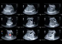  Liver ultrasound panel, used in hepatocellular carcinoma evaluation and CEUS perfusion analysis.&nbsp;