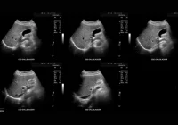 Abdominal ultrasound images showing the gallbladder and common bile duct for diagnostic evaluation.&nbsp;