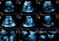 Composite image of abdominal ultrasound scans showing organs including the kidneys, liver, spleen, gallbladder, bile duct, and pancreas, used for diagnostic imaging and clinical assessment.&nbsp;