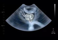 Transrectal ultrasound showing the prostate gland for urology imaging and diagnosis.&nbsp;
