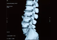 3D CT scan of the lumbar spine showing vertebrae and degenerative structural changes.&nbsp;