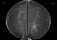 High-resolution mammography scan showing breast tissue on a black background.&nbsp;