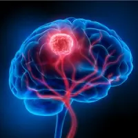 MR-Guided Ultrasound&nbsp;Delivers Antibody Therapy to Brain Tumours