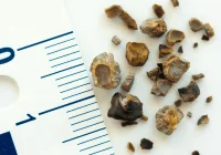 Improving Kidney Stone Diagnosis with Radiomics and PCCT