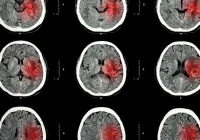 Predicting Early Haematoma Expansion: Nomograms vs. Machine Learning