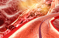 Cardiac Transthyretin Amyloidosis Treatment and Outcomes After Aortic Valve Replacement